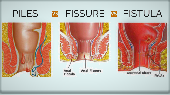 piles and fissure and fistula